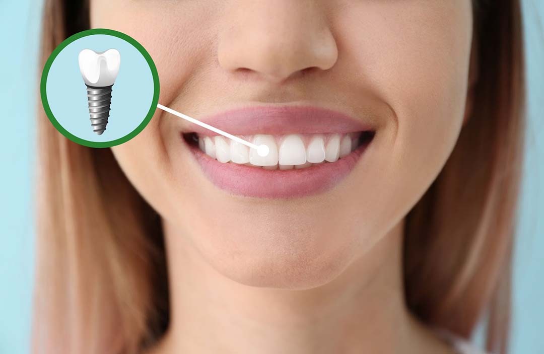 IMPLANTE DENTAL