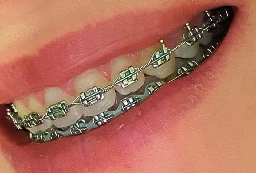 BRACKETS