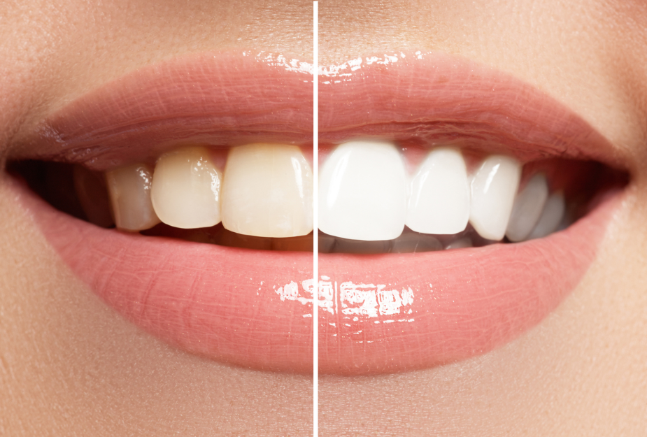 BLANQUEAMIENTO DENTAL